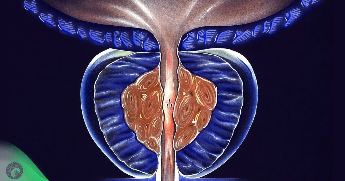 Hiperplasia Prostática Benigna (HPB)